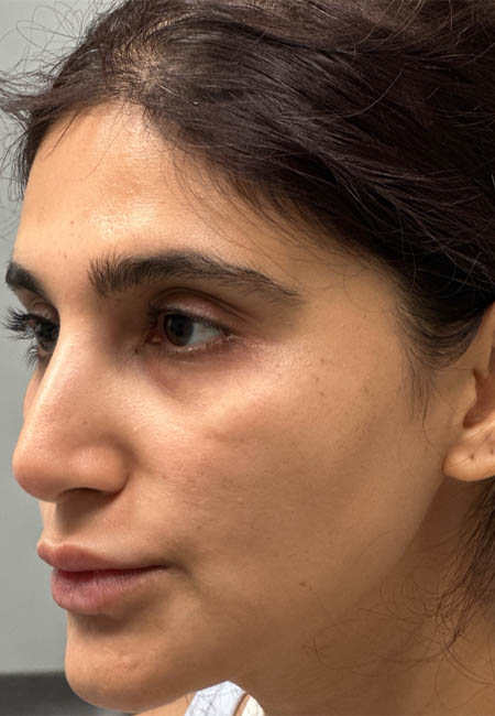 1_0000_BEFORE CHEEK FILLER -SIDE.png
