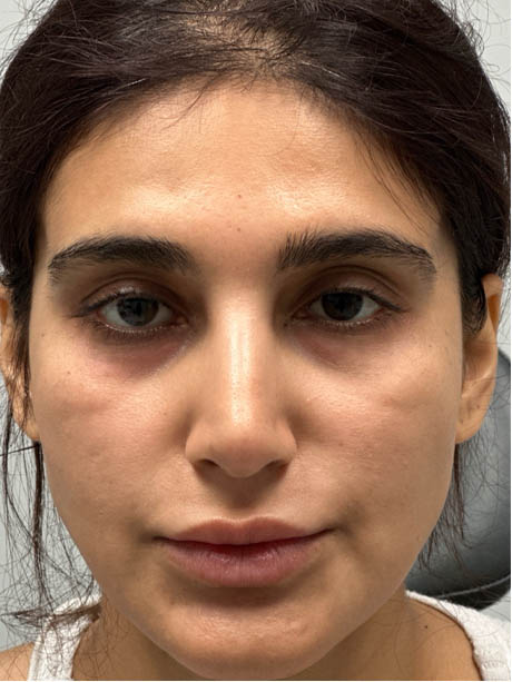 1_0000_BEFORE SUBBROW FILLER .png