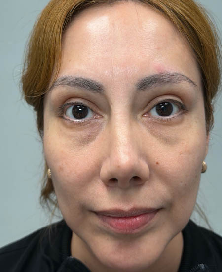 1_0000_after dissolving under eye filler.png