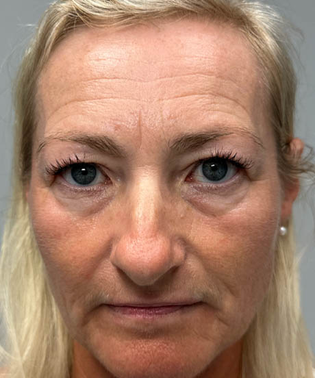 1_0000_before upper bleph with temporal brow lift and facial fat grafting to subbrows- front.png