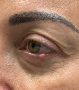 1_0000_patient 2 before lesion removal.PNG