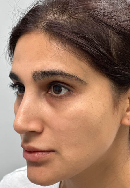 1_0001_AFTER CHEEK FILLER-SIDE.png