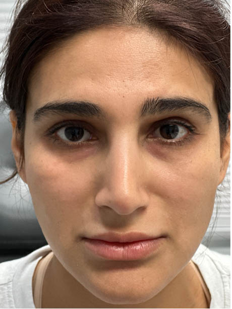 1_0001_AFTER SUBBROW FILLER .png