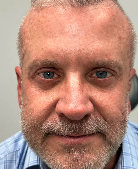 1_0001_AFTER UPPER AND LOWER BLEPH WITH FACIAL FAT GRAFTING AND CANTHOPLASTY.png