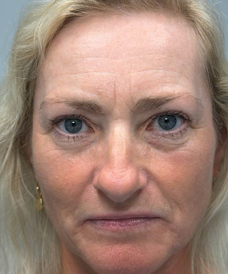 1_0001_after upper bleph with temporal brow lift and facial fat grafting to subbrows- front.png