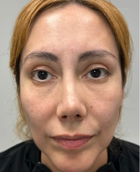 1_0001_before dissolving under eye filler.png