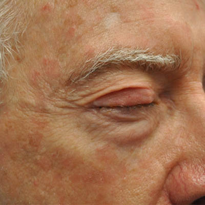 1_0001_patient 1 after skin cancer repair.PNG