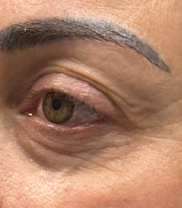 1_0001_patient 2 after lesion removal.PNG