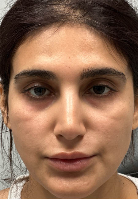 1_0002_BEFORE CHEEK FILLER.png