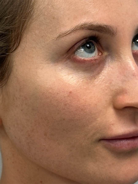 1_0002_BY NICOLE- before 3D MIRACL- right side.png