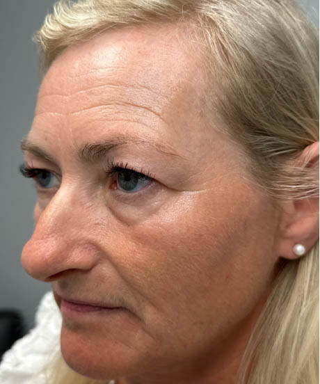 1_0002_before upper bleph with temporal brow lift and facial fat grafting to subbrows- left side.png