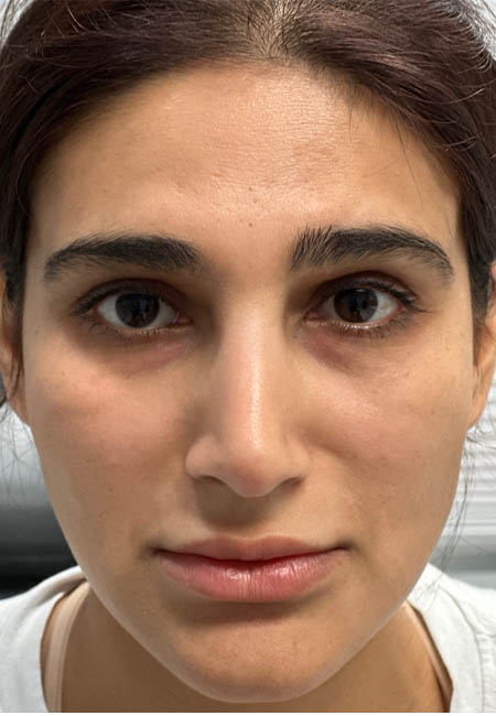 1_0003_AFTER CHEEK FILLER.png