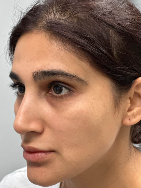 1_0003_AFTER SUBBROW FILLER-SIDE.png