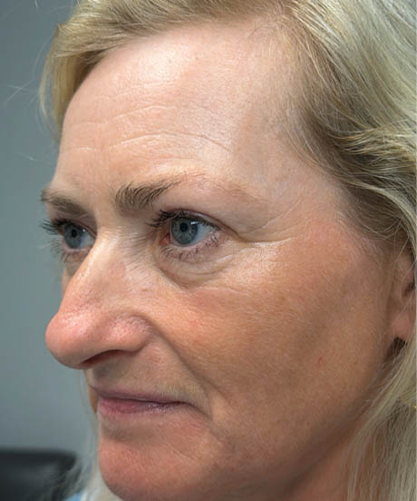 1_0003_after upper bleph with temporal brow lift and facial fat grafting to subbrows- left side.png