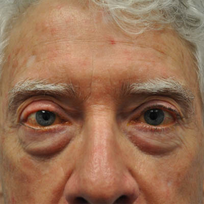 1_0003_patient 3 after skin ca repair.PNG