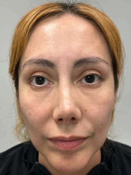 1_0004_before subbrow filler.png