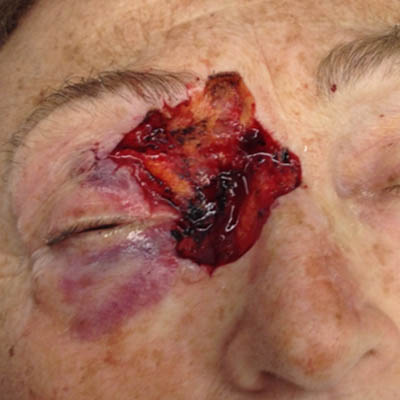 1_0004_patient 4 before skin ca repair.PNG