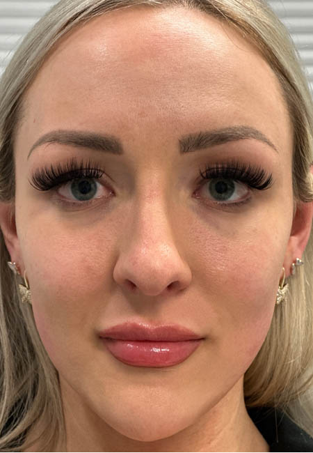 1_0005_AFTER FILLER CHEEKS AND CHIN.JAWLINE.png