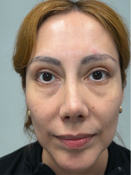 1_0005_after subbrow filler.png