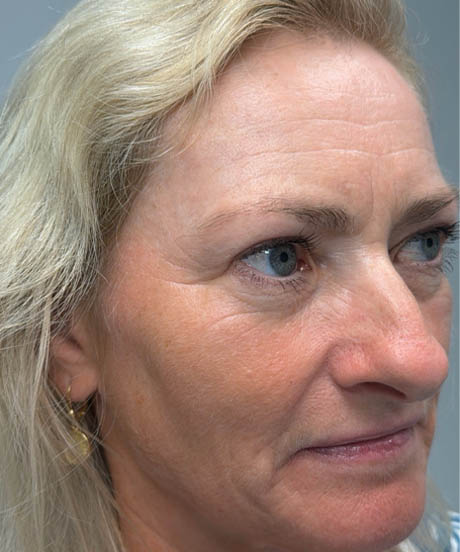 1_0005_after upper bleph with temporal browlift and facial fat grafting to subbrows- right side.png