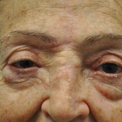 1_0005_patient 4 after skin ca repair.PNG