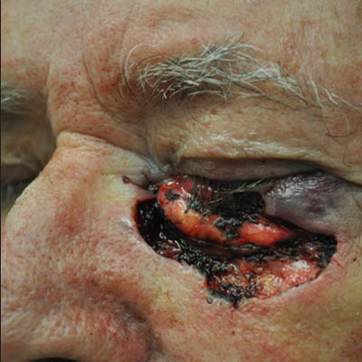 1_0006_patient 5 before skin ca repair.PNG