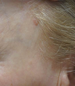 1_0006_patient 6 before lesion remova.PNG