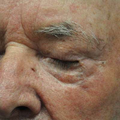 1_0007_patient 5 after skin ca repair.PNG
