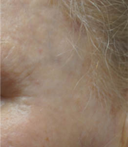 1_0007_patient 6 after lesion remova.PNG