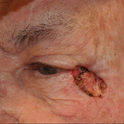 1_0008_patient 6 before skin ca repair.PNG