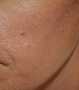 1_0010_patient 8 before lesion removal.PNG
