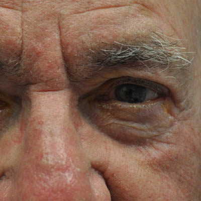 1_0011_patient 7 after skin ca repair.PNG