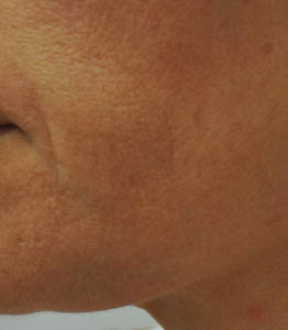 1_0011_patient 8 after lesion removal.PNG