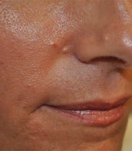 1_0012_patient 9 before lesion removal.PNG