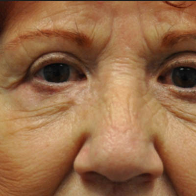 1_0013_patient 8 after skin ca repair.PNG