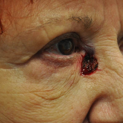 1_0014_patient 9 before skin ca repair.PNG