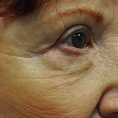 1_0015_patient 9 after skin ca repair.PNG