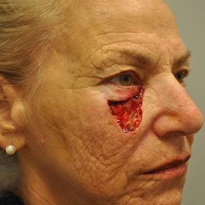 1_0016_patient 10 before skin ca repair.PNG
