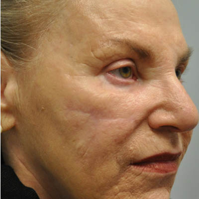 1_0017_patient 10 after skin ca repair.PNG