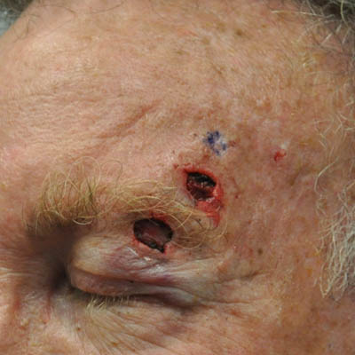 1_0018_patient 11 before skin ca repair.PNG