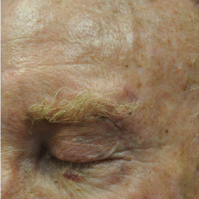 1_0019_patient 11 after skin ca repair.PNG