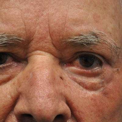 1_0021_patient 12 after skin ca repair.PNG