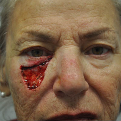 1_0022_patient 14 before skin ca repair.PNG