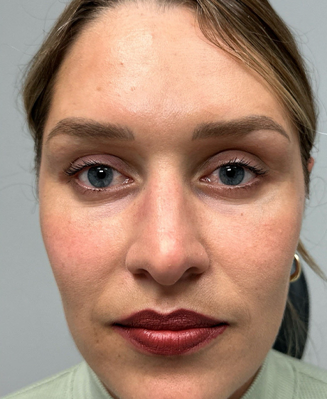 after lower bleph with facial fat grafting and CO2 laser- front