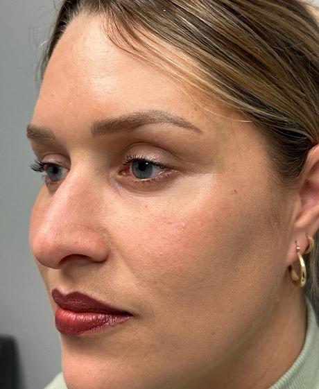 after lower bleph with facial fat grafting and CO2 laser- side