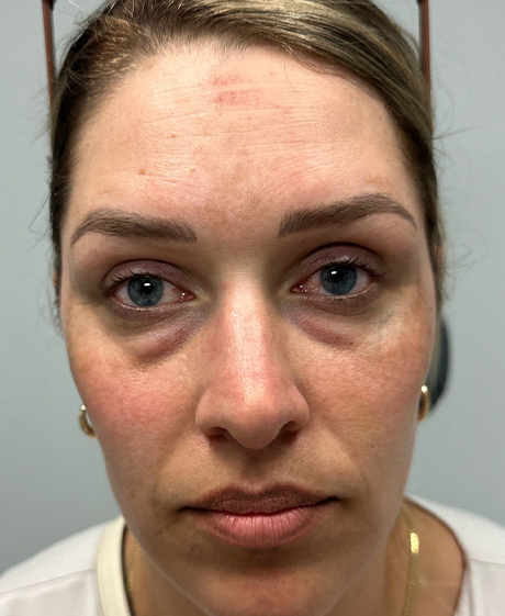 before lower bleph with facial fat grafting and CO2 laser- front