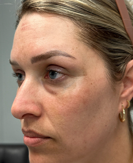 before lower bleph with facial fat grafting and CO2 laser- side