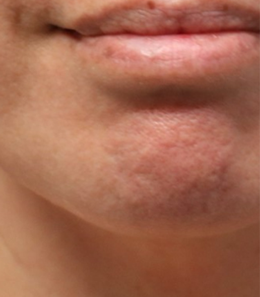 patient 1 after lesion removal (front).PNG