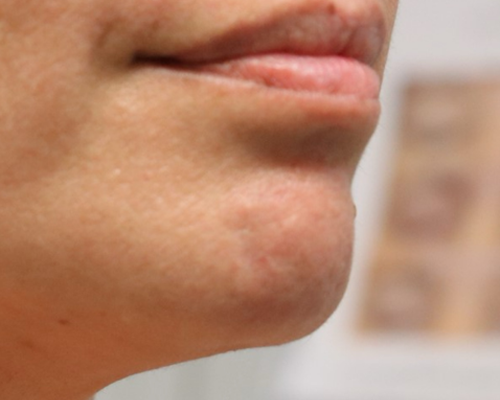 patient 1 after lesion removal.PNG