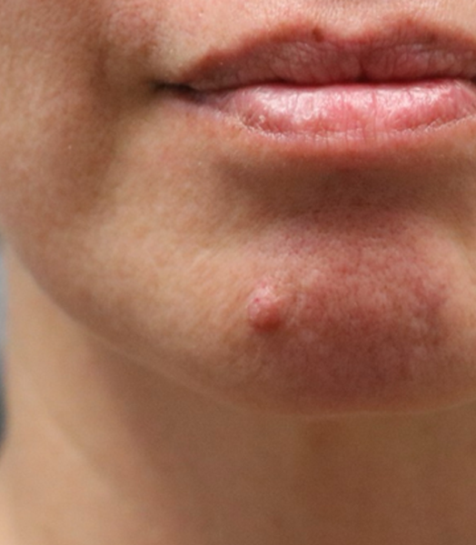 patient 1 before lesion removal (front).PNG